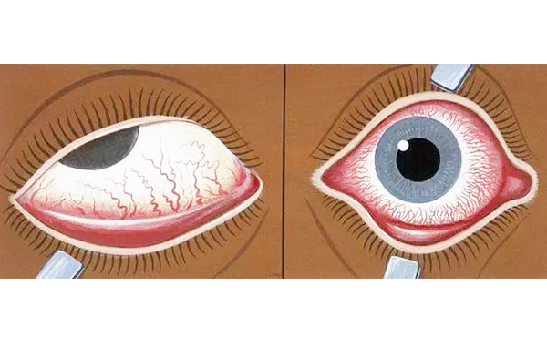 眼睑缺损的危害是什么?影响眼睑矫正的因素是什么?