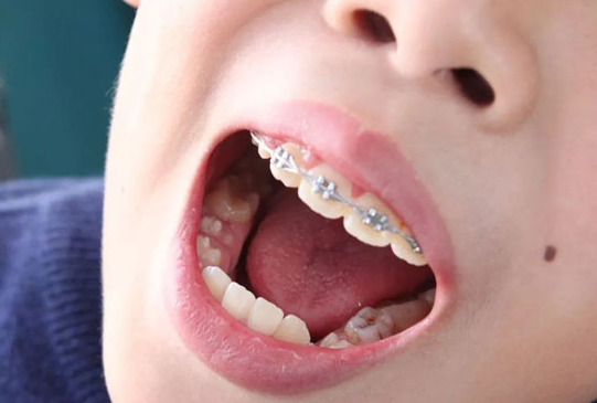 儿童牙齿矫正费用大约多少钱？