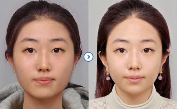 影响瘦脸针效果的因素有哪些?