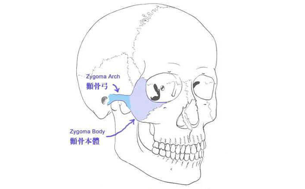 什么样的脸型需要做颧骨整形？