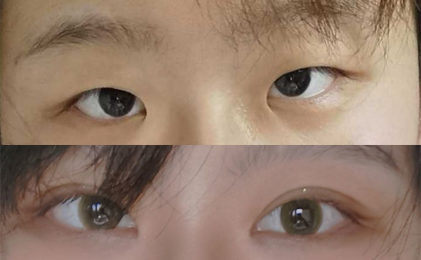 小眼症矫正的具体方式有哪些?术后会留疤吗?