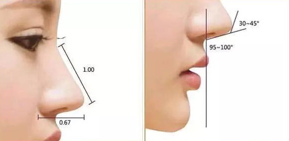 鼻翼缩小手术图