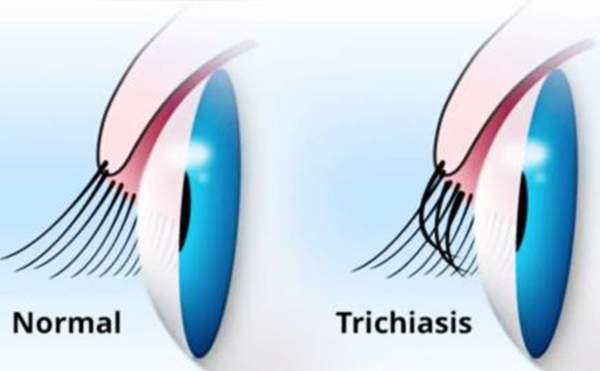 倒睫与乱睫的区别是什么?倒睫与乱睫怎么办?