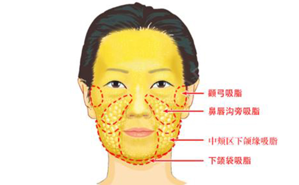 面部吸脂有哪些部位？