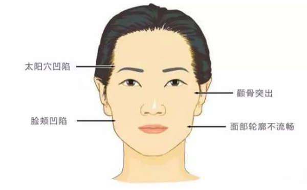 颧骨高或颧骨外扩应该怎么办?