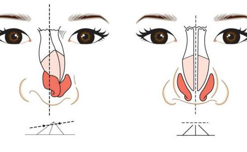 歪鼻矫正手术大概多少钱？歪鼻矫正手术成功率为多少？