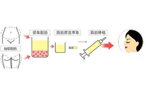 去眼袋后下眼睑为什么凹陷?去眼袋后下眼睑凹陷怎么办?