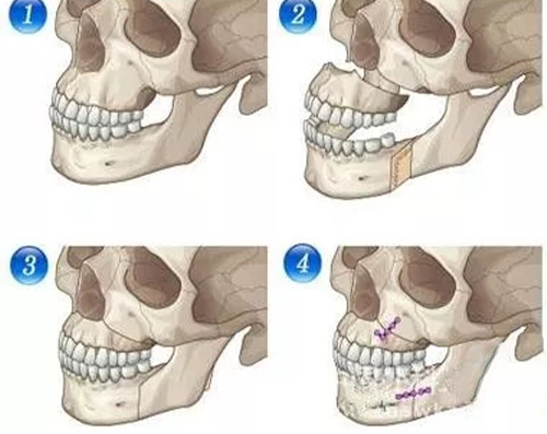 正颌手术步骤图