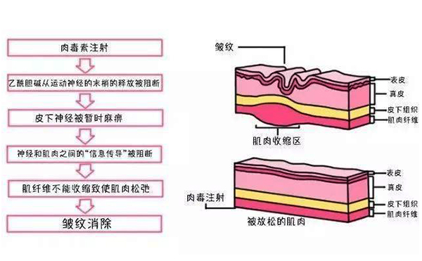 眼部皱纹的形成原因是什么?眼部除皱有什么方法?