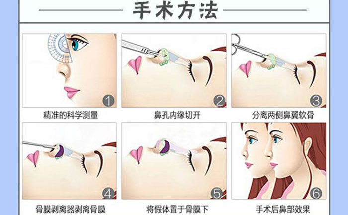 隆鼻假体取出后能恢复到以前吗？