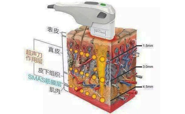 超声刀的原理是什么?效果怎么样?