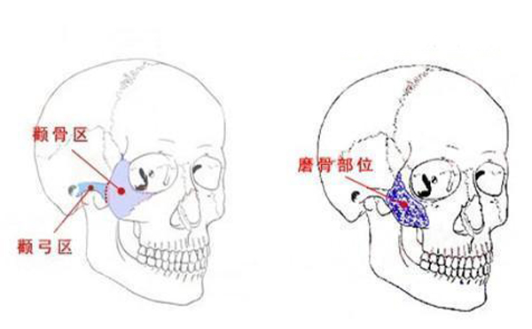 颧骨整形一般是从哪里切口？