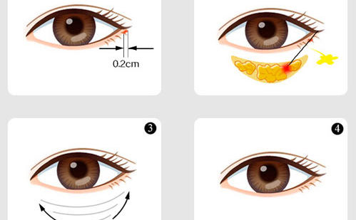内切眼袋怎么做？