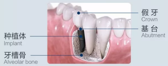 美奥口腔牙齿种植技术