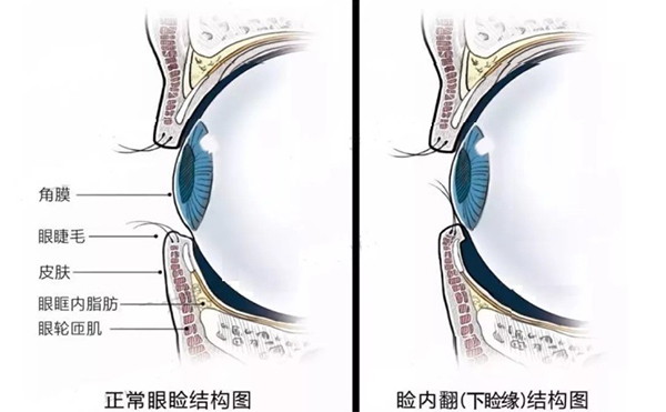 眼睑内翻什么意思?眼睑内翻怎么办?