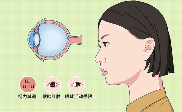 眼球突出什么原因?如何矫正?