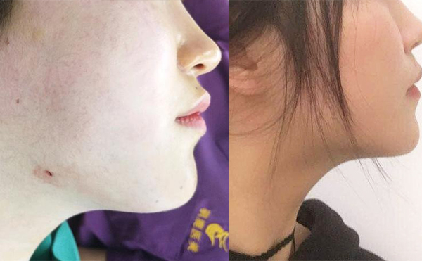 面部吸脂恢复期多长时间？