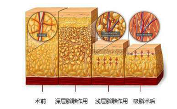 韩式分层吸脂的效果怎么样？