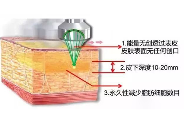 超声波吸脂怎么瘦手臂？