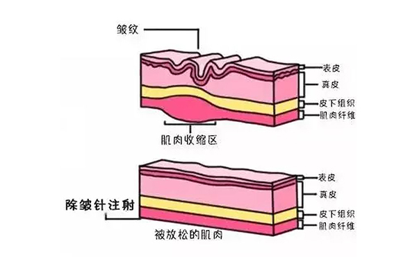 注射除皱是什么原理？