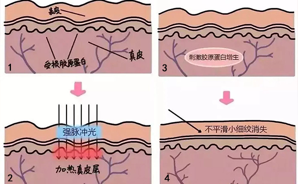 光子嫩肤去鱼尾纹