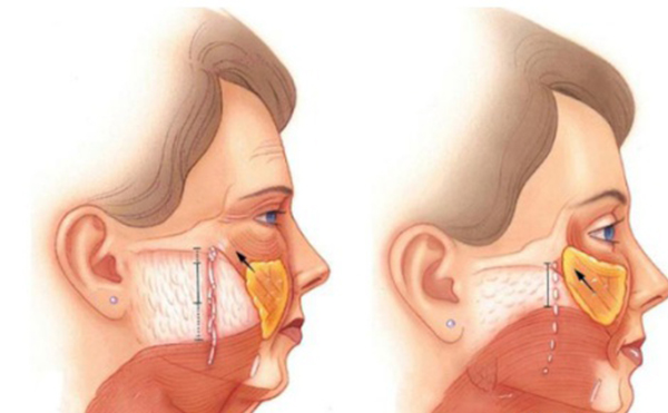 筋膜悬吊除皱是什么原理？