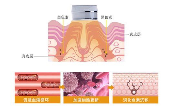 光子嫩肤效果好不好？