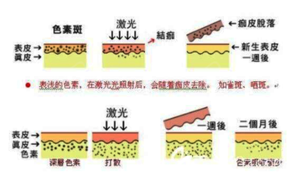 光子嫩肤和皮秒有什么区别？