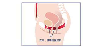 盆底肌修复术后