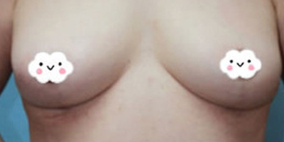 女性乳房缩小术后