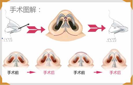 缩鼻头手术可以保持多久？缩鼻头手术术后注意事项？