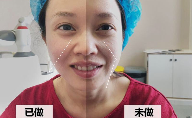 激光溶脂瘦脸的副作用及效果？光纤溶脂瘦脸多久可以见效？
