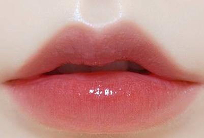 玻尿酸丰唇能保持多长时间？玻尿酸丰唇多久消肿？