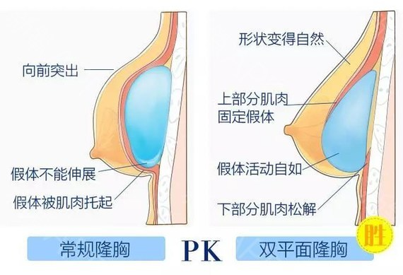 假体隆胸修复怎么做？做隆胸修复能维持多久？