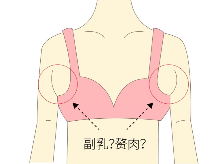 手术去副乳效果怎么样？手术去副乳要注意什么？