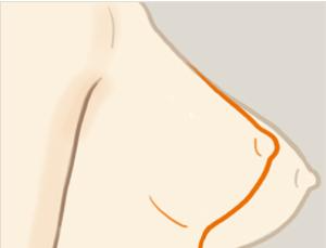 乳房下垂矫正手术风险有多大？ 乳房下垂矫正术多久能恢复？