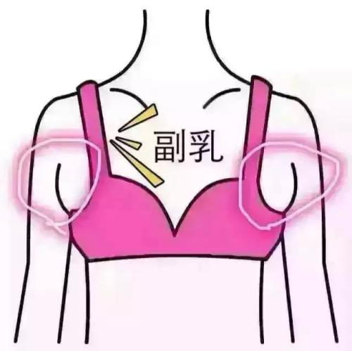 吸脂做副乳要多少钱？吸脂去副乳会反弹吗？