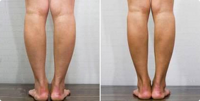 什么是射频脂溶瘦小腿 射频溶脂瘦小腿能保持多久