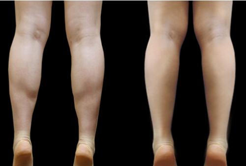 超声溶脂瘦大腿的费用 超声溶脂瘦大腿如何保持护理