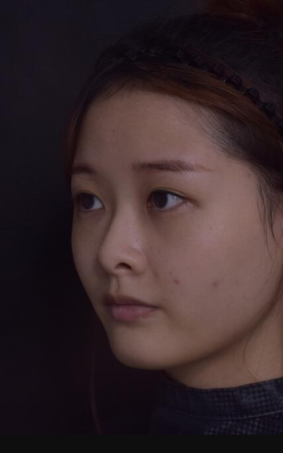 上海艺星医疗美容医院做隆鼻手术前的鼻子