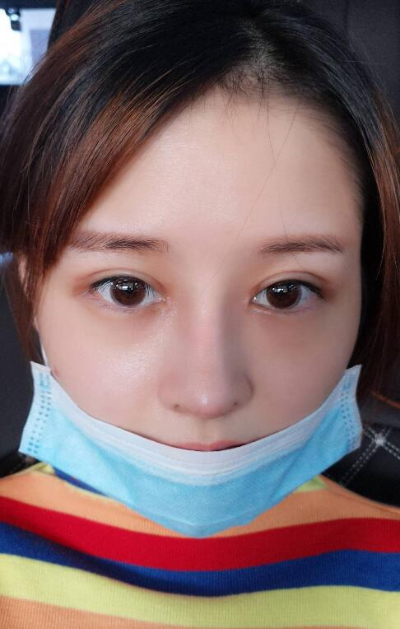上海艺星医疗美容医院做隆鼻手术后的恢复情况