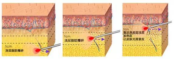 优立塑的原理是什么 优立塑禁忌人群