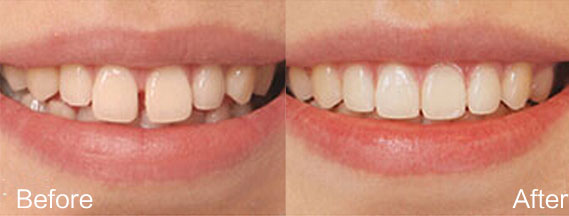安庆渡江口腔医院牙齿修复优点效果怎么样？