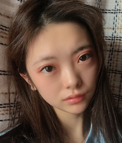 安徽韩美整形美容医院做双眼皮手术的第七天