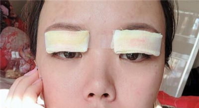 珠海韩妃医疗美容门诊部做双眼皮手术后的情形