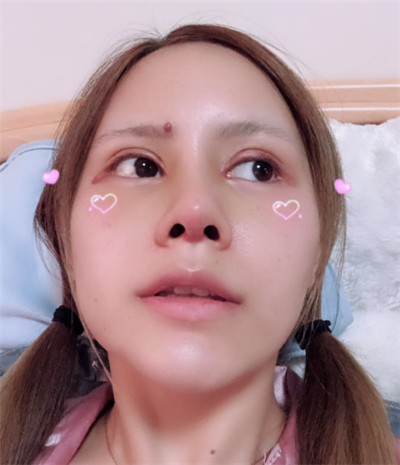 深圳弘美医疗美容门诊部做眼综合手术后的恢复情况