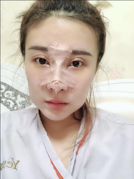 上海艺星医疗美容医院做鼻综合术后的第三天