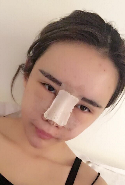 上海伊美尔港华医疗美容医院做自体肋软骨隆鼻手术刚刚结束
