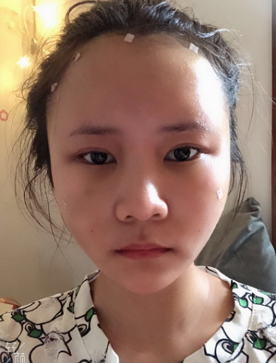 上海美莱医疗美容门诊部做面部填充刚刚做完手术后的情况
