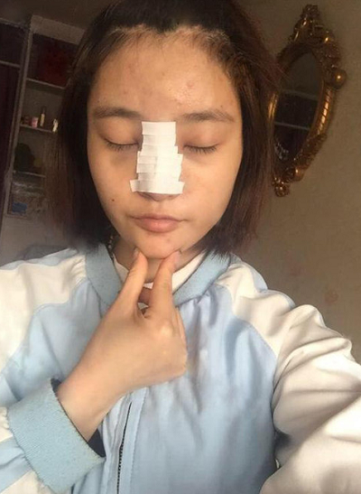 上海玫瑰医疗美容医院杨硕成做硅胶隆鼻案例效果分享